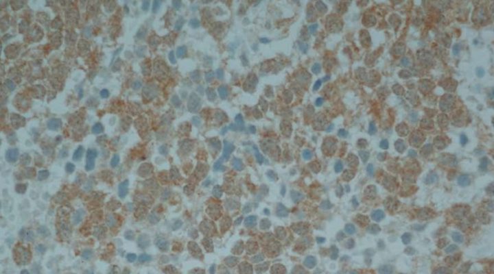 Avances en la validación clínica de una terapia contra un tumor pediátrico agresivo