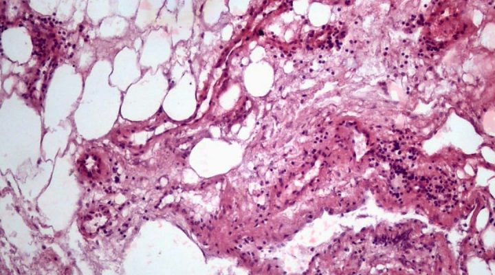 Revelan que el cáncer renal modifica las células grasas de su entorno y genera condiciones que podrían favorecer su progresión
