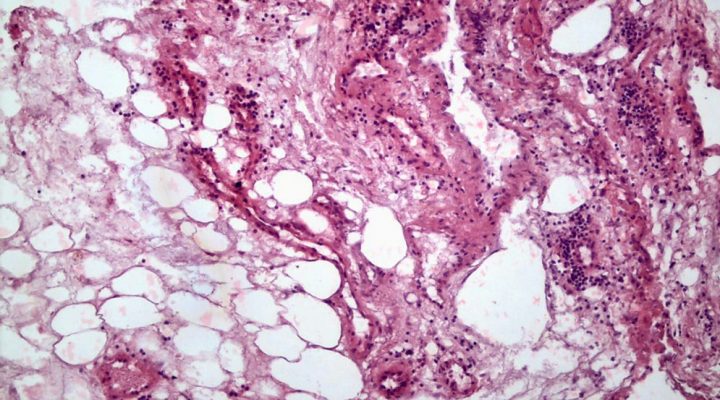 Revelan que el cáncer renal modifica las células grasas de su entorno y genera condiciones que podrían favorecer su progresión